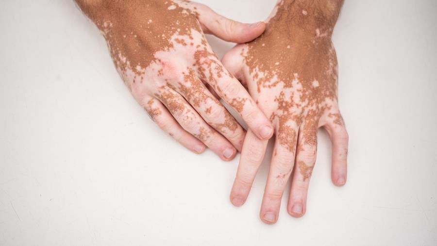 "Het is duidelijk dat de aanpak van vitiligo verbeterd kan worden"