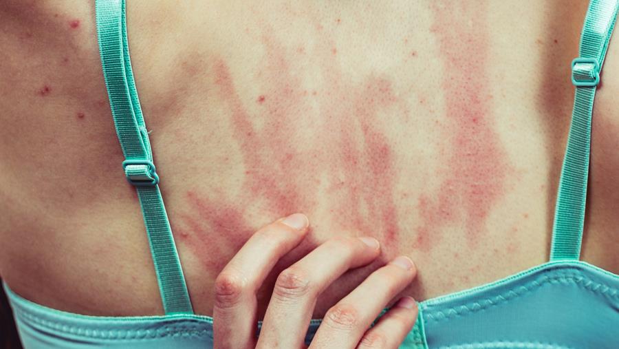 L’IA accélère et fiabilise l’interprétation des tests cutanés d’allergie