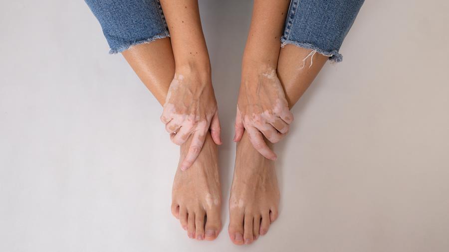 Vitiligo : efficacité prolongée du ruxolitinib topique